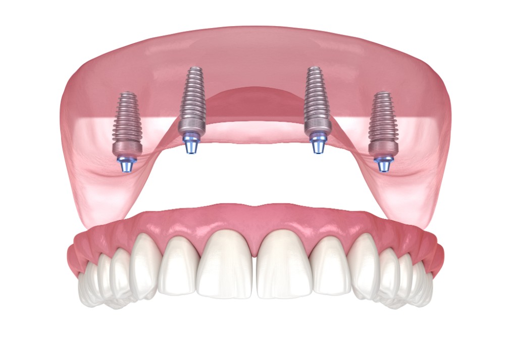 Fixed hybrid implants